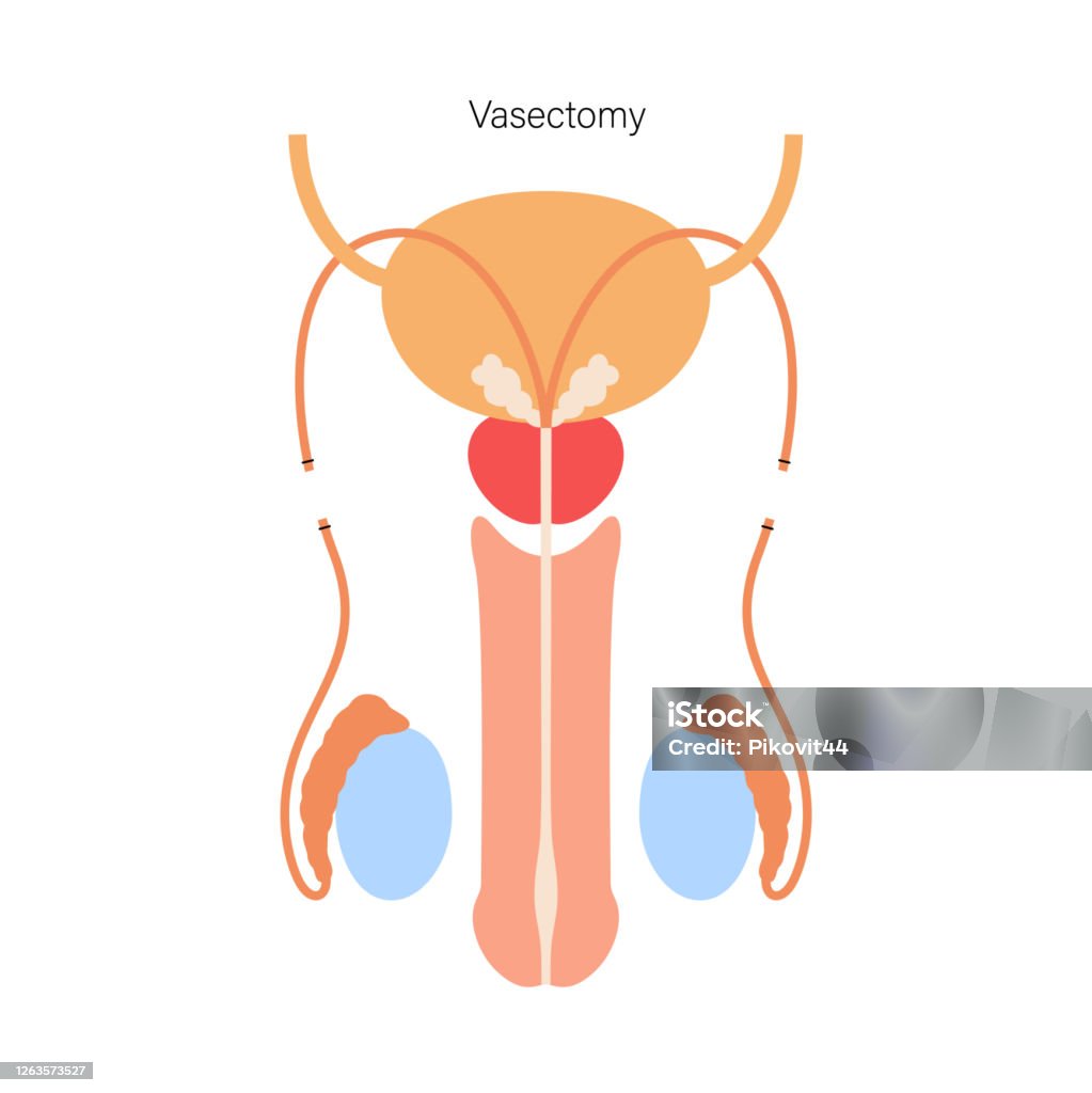 Vasectomy Myths and Facts for Men in NZ